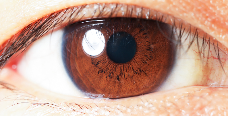 黃斑變性類(lèi)型